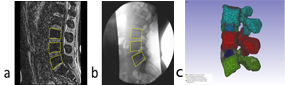 Individualised disc loading combing a. 3-D volumetric MRI, b. QF motion sequence, c. Finite element model