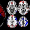 cold water MRI brain scans 