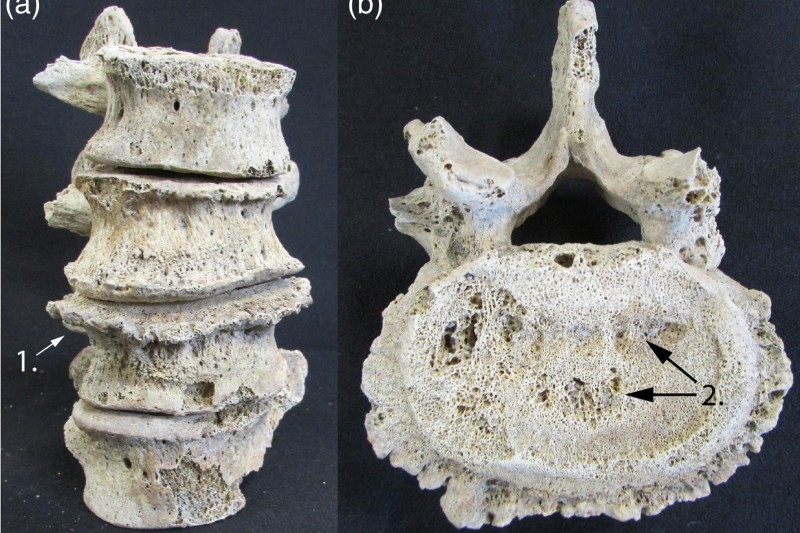 A section of the spine show degeneration to the vertebrae