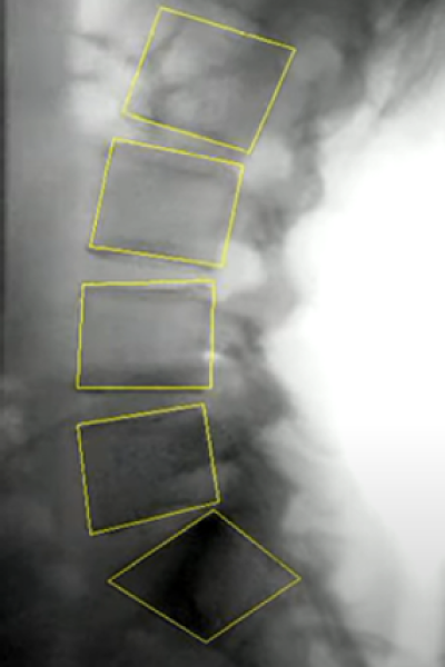 Reference database of intervertebral motion