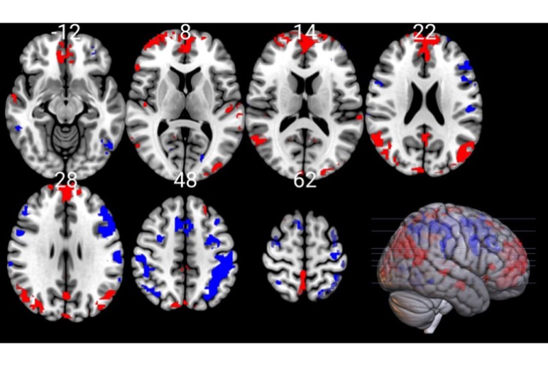 MRI scans with parts of the brain showing blue, and parts showing red. 