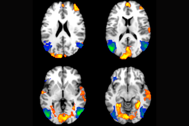 4 MRI scans of the brain, each contain orange, green and blue patches which indicate areas of the brain activated during the study